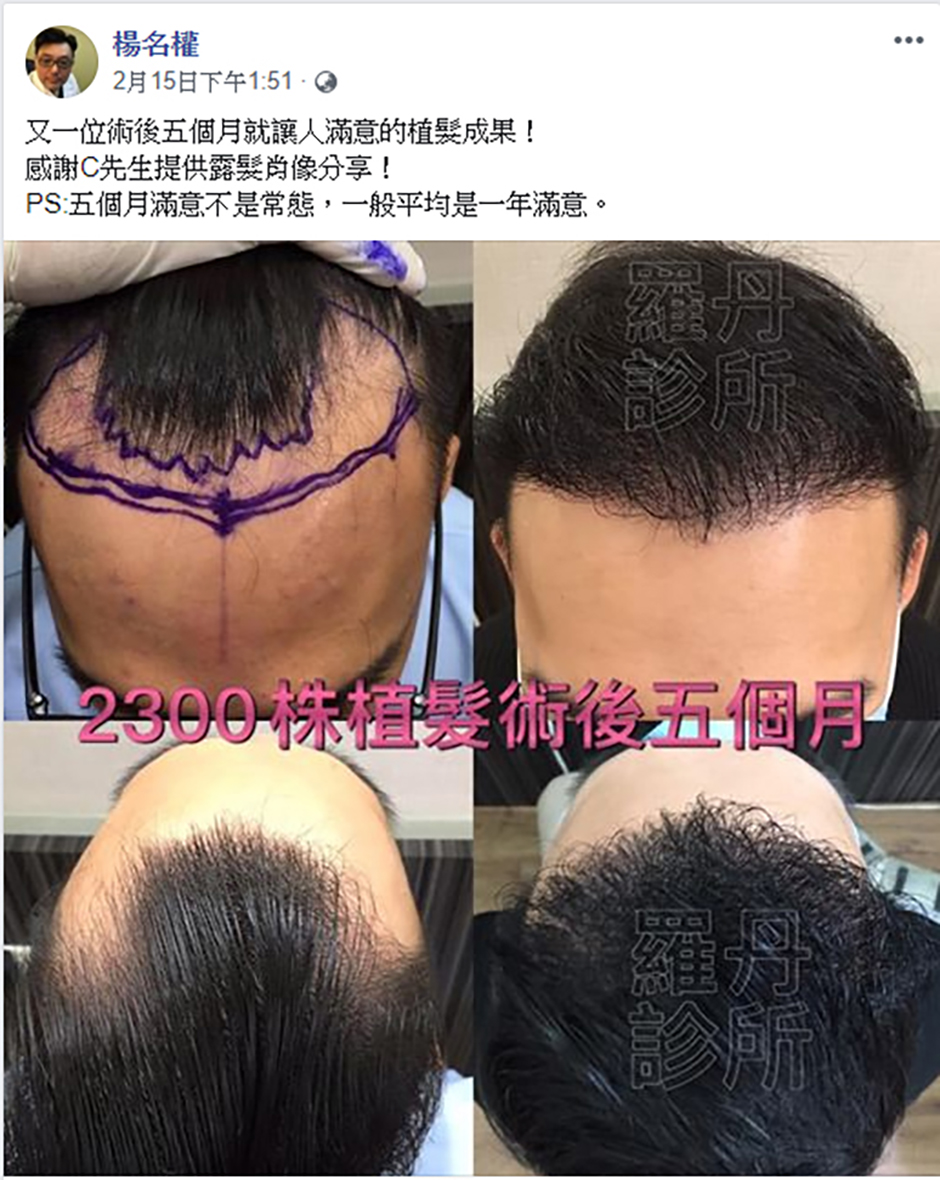 植髮,掉髮,楊氏羅丹,生髮613